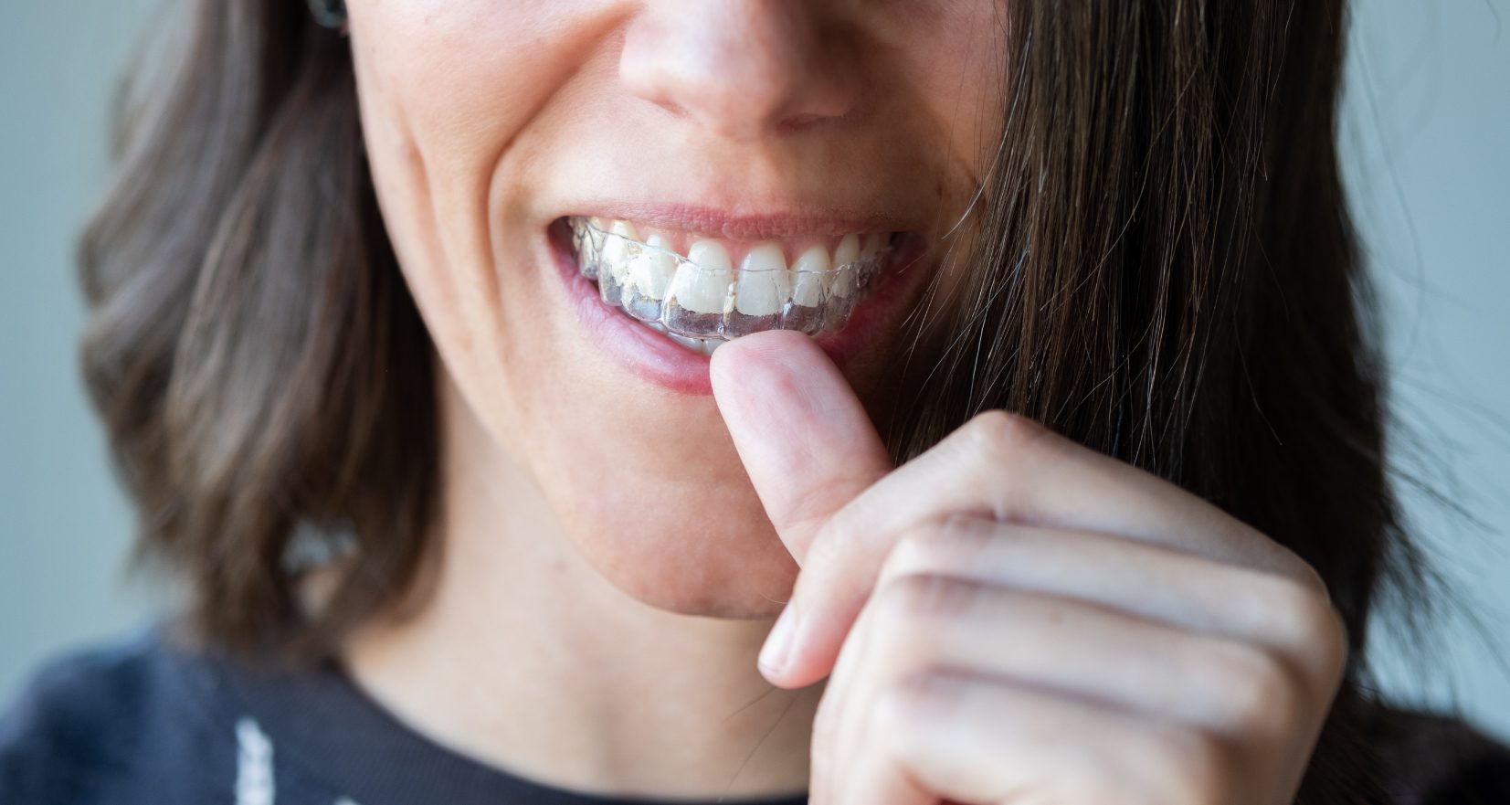 20 Best Dental Invisalign Marketing Strategies for Dentists [Video]